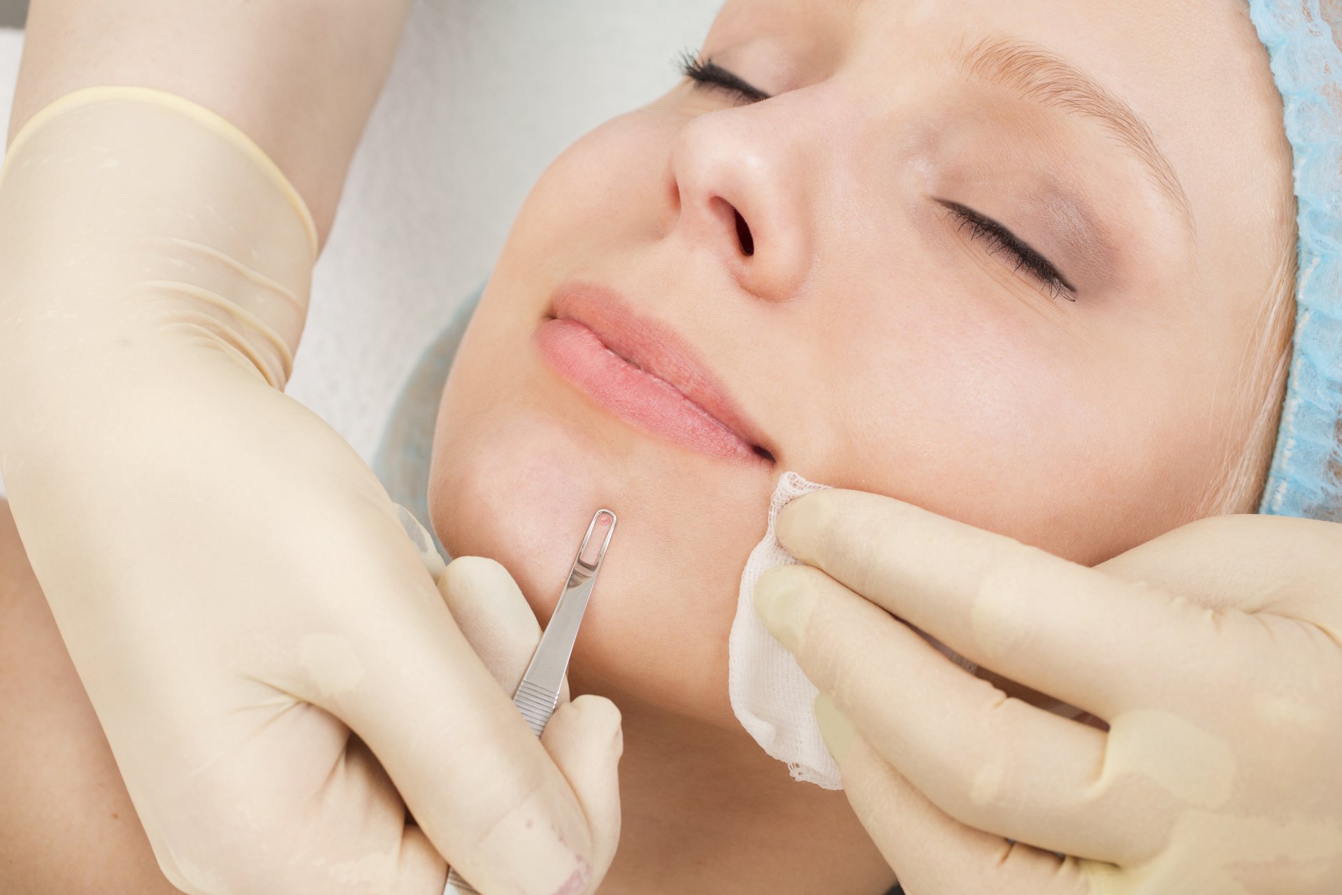 limpeza de pele para acne